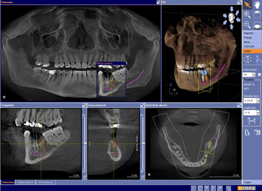 Radiografii 3D CRANEX3D